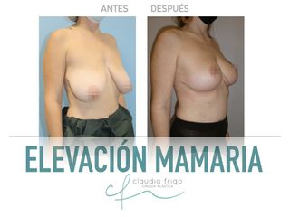 Reducción de senos - Dra. Claudia Frigo