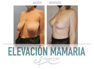 Reducción de senos - Dra. Claudia Frigo