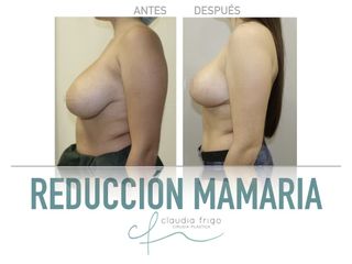 Reducción de senos - Dra. Claudia Frigo