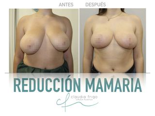 Reducción de senos - Dra. Claudia Frigo