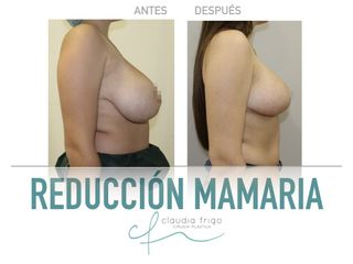 Reducción de senos - Dra. Claudia Frigo