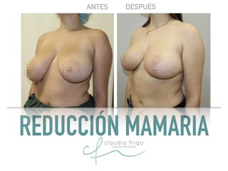 Reducción de senos - Dra. Claudia Frigo