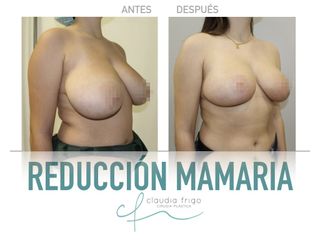 Reducción de senos - Dra. Claudia Frigo