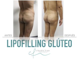 Lipofilling glúteo - Dra. Claudia Frigo