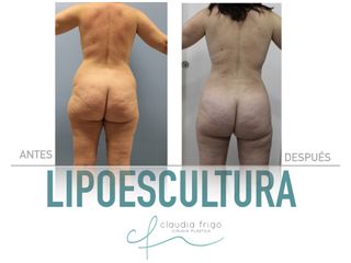 Lipoescultura - Dra. Claudia Frigo