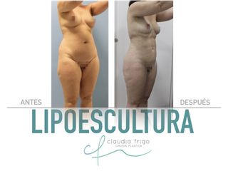 Lipoescultura - Dra. Claudia Frigo