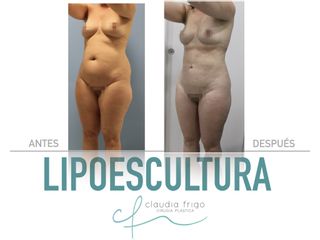 Lipoescultura - Dra. Claudia Frigo