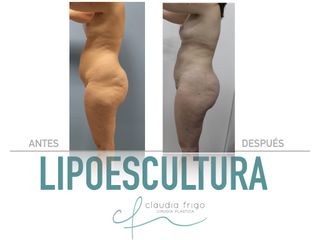 Lipoescultura - Dra. Claudia Frigo
