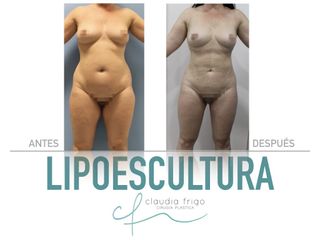 Lipoescultura - Dra. Claudia Frigo