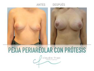 Mastopexia - Dra. Claudia Frigo