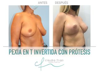 Mastopexia - Dra. Claudia Frigo