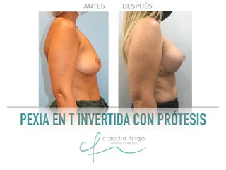 Mastopexia - Dra. Claudia Frigo