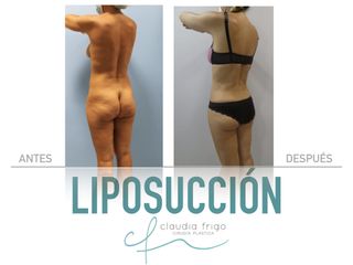 Liposucción - Dra. Claudia Frigo