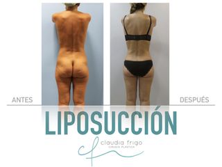 Liposucción - Dra. Claudia Frigo