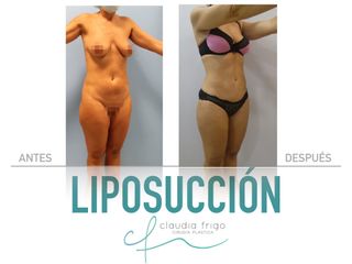 Liposucción - Dra. Claudia Frigo