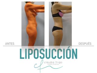 Liposucción - Dra. Claudia Frigo