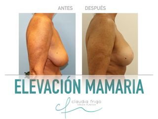 Elevación de pecho - Dra. Claudia Frigo
