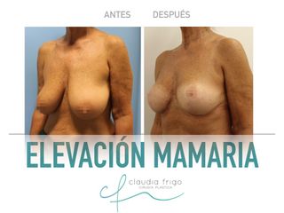 Elevación de pecho - Dra. Claudia Frigo