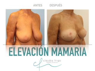 Elevación de pecho - Dra. Claudia Frigo