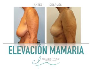 Elevación de pecho - Dra. Claudia Frigo