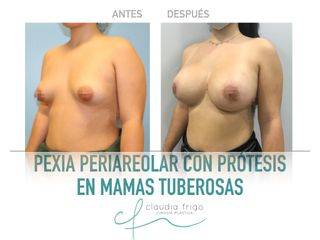 Mastopexia - Dra. Claudia Frigo