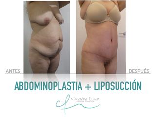 Abdominoplastia + Liposucción - Dra. Claudia Frigo