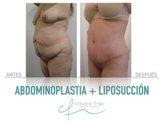 Abdominoplastia + Liposucción - Dra. Claudia Frigo