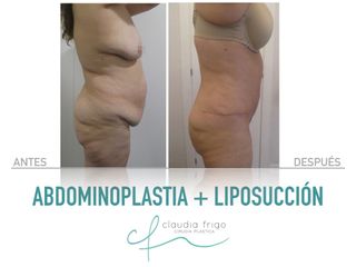 Abdominoplastia + Liposucción - Dra. Claudia Frigo