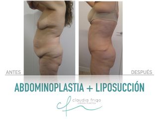 Abdominoplastia + Liposucción - Dra. Claudia Frigo
