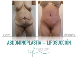 Abdominoplastia + Liposucción - Dra. Claudia Frigo