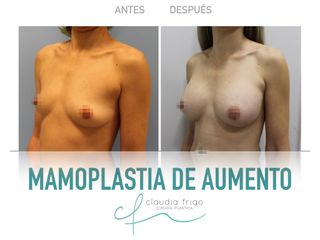 Mamoplastia de aumento - Dra. Claudia Frigo