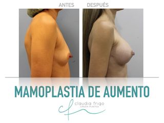 Mamoplastia de aumento - Dra. Claudia Frigo