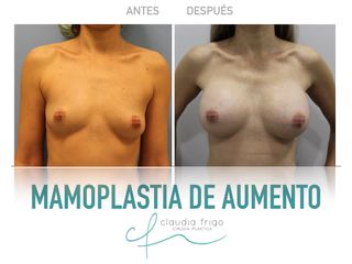 Mamoplastia de aumento - Dra. Claudia Frigo