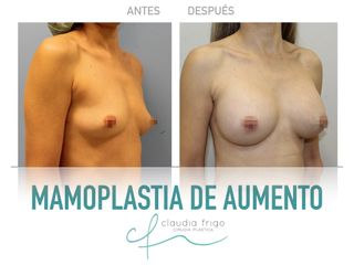 Mamoplastia de aumento - Dra. Claudia Frigo