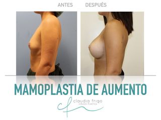 Mamoplastia de aumento - Dra. Claudia Frigo