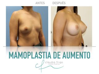 Mamoplastia de aumento - Dra. Claudia Frigo