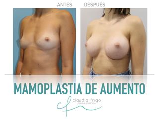 Aumento de pecho - Dra. Claudia Frigo