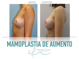 Aumento de pecho - Dra. Claudia Frigo