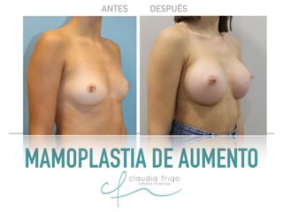 Aumento de pecho - Dra. Claudia Frigo