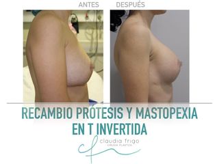 Mastopexia - Dra. Claudia Frigo