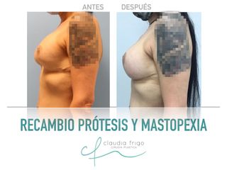 Mastopexia - Dra. Claudia Frigo