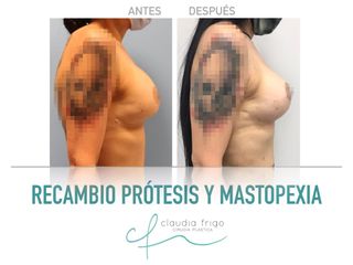 Mastopexia - Dra. Claudia Frigo