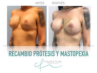Mastopexia - Dra. Claudia Frigo
