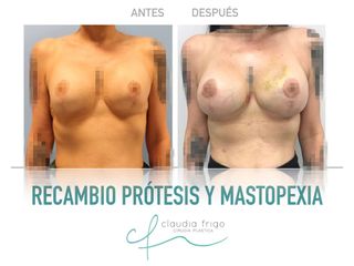 Mastopexia - Dra. Claudia Frigo