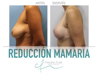 Reducción de senos - Dra. Claudia Frigo