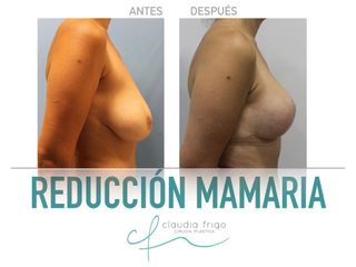 Reducción de senos - Dra. Claudia Frigo