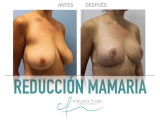 Reducción de senos - Dra. Claudia Frigo