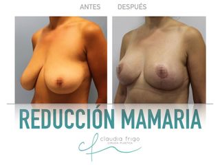 Reducción de senos - Dra. Claudia Frigo