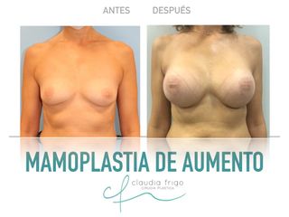 Aumento de pecho - Dra. Claudia Frigo