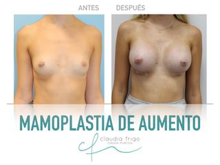 Aumento de pecho - Dra. Claudia Frigo